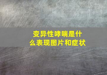 变异性哮喘是什么表现图片和症状