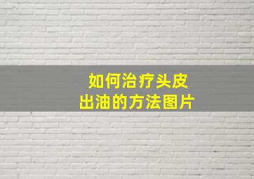 如何治疗头皮出油的方法图片