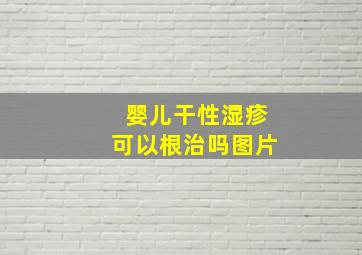 婴儿干性湿疹可以根治吗图片