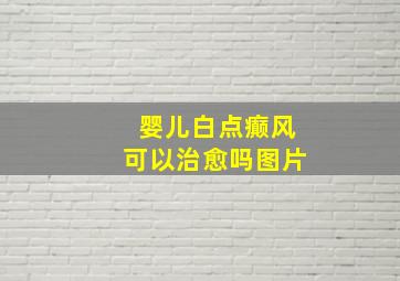 婴儿白点癫风可以治愈吗图片