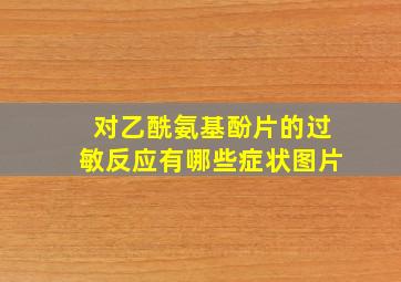 对乙酰氨基酚片的过敏反应有哪些症状图片