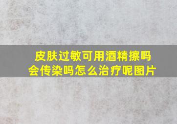 皮肤过敏可用酒精擦吗会传染吗怎么治疗呢图片