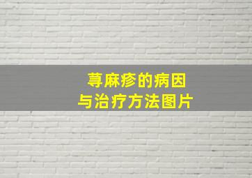 荨麻疹的病因与治疗方法图片