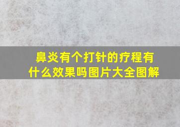 鼻炎有个打针的疗程有什么效果吗图片大全图解